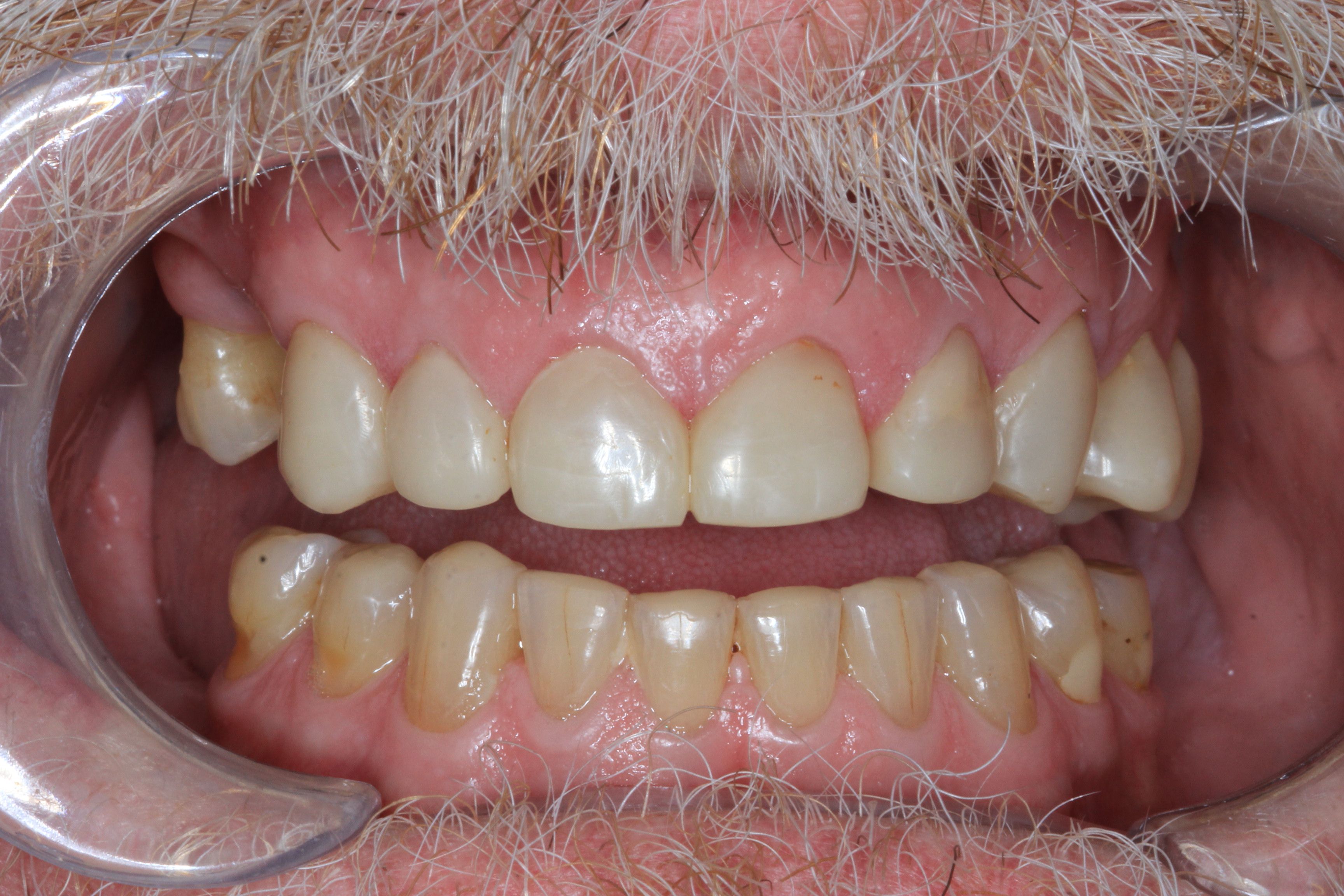 after composite bonding