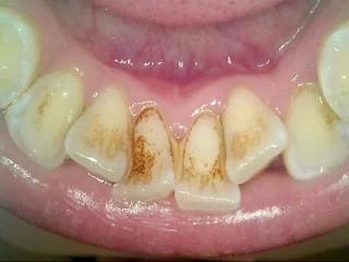 Dental Cleaning 1 - Before