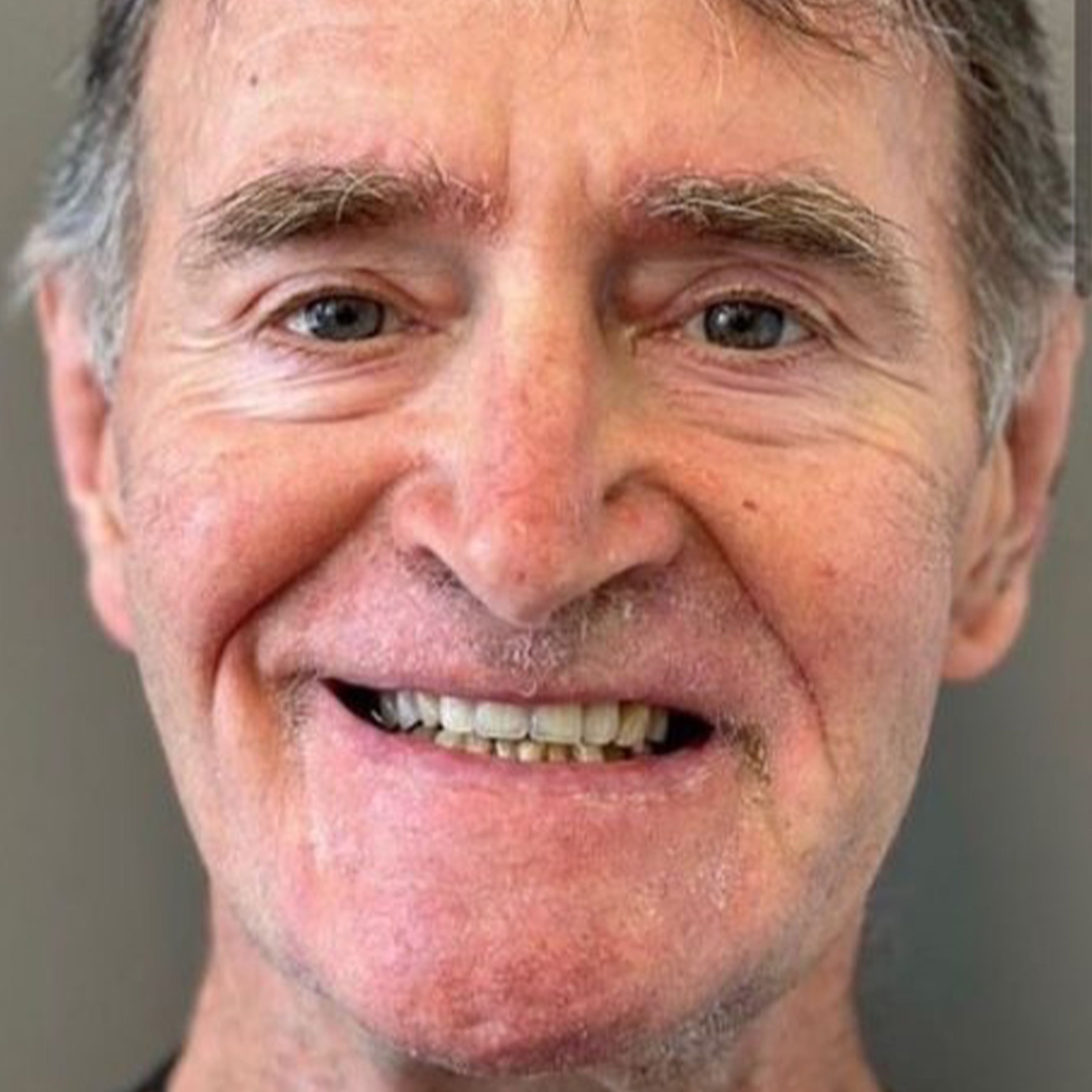 Upper Partial Denture After