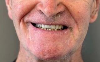 Upper Partial Denture After