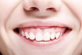 What causes a gummy smile?