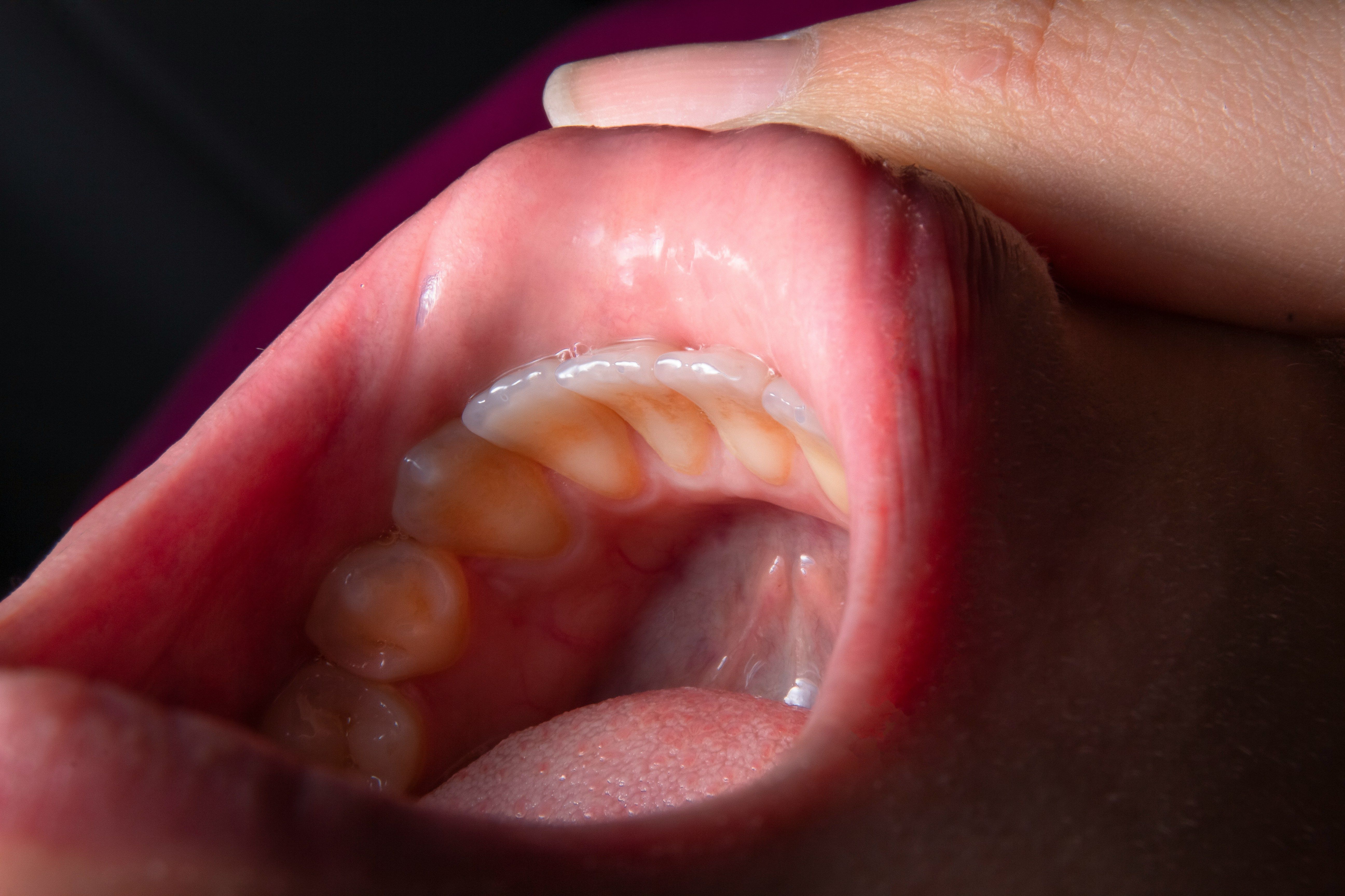 lump inside mouth