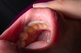 lump inside mouth