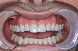 after implant