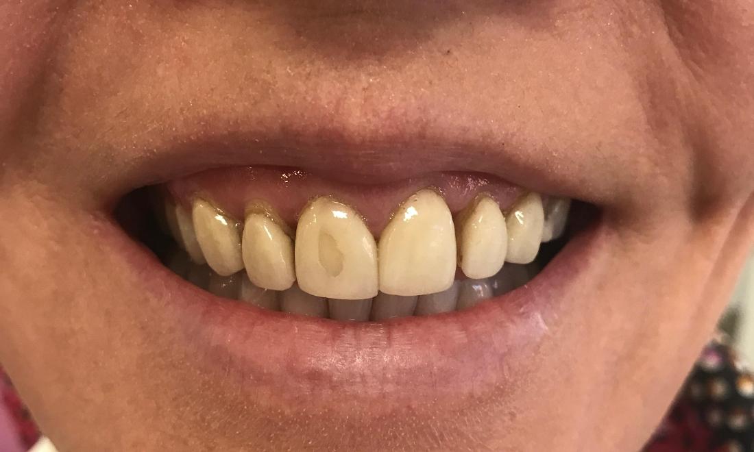 Veneers - Before