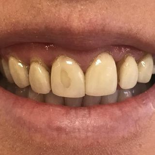 Veneers - Before