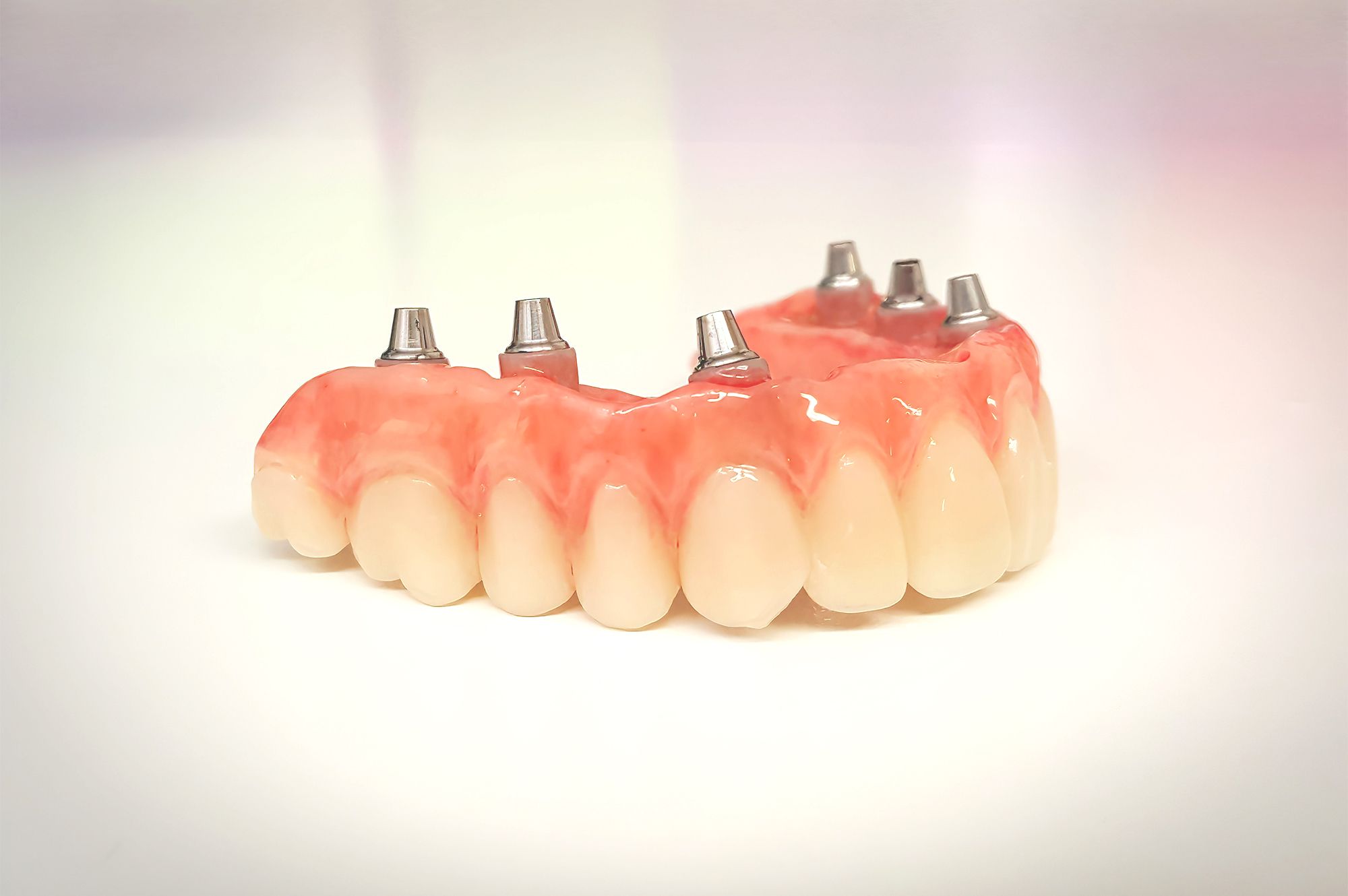 Overdentures