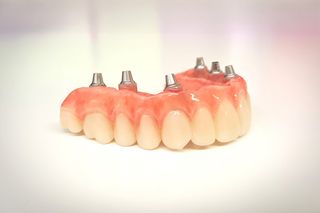 Overdentures