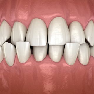 3D render of crossbite teeth.