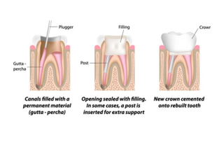 Image of the second three stages of a root canal procedure.