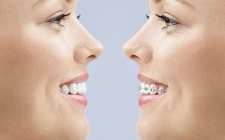 Comparing Invisalign vs braces