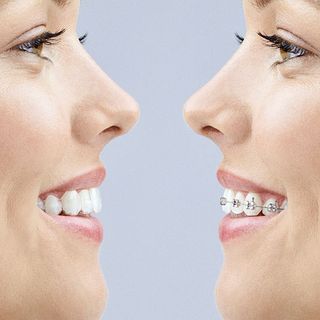 How does Invisalign® work?
