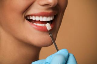 What are Dental Veneers?