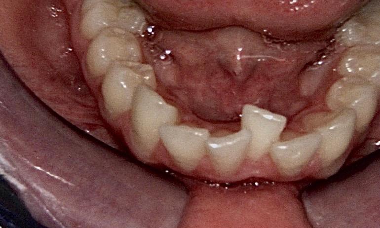 Braces and Invisalign - Before