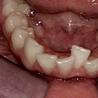 Braces and Invisalign - Before