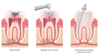 Stages of a root canal - from infected tooth to removal of tooth