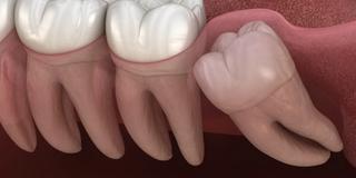 What's the deal with cavities?