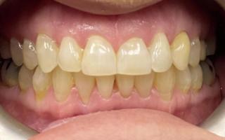 Before image of a patient of teeth whitening. 