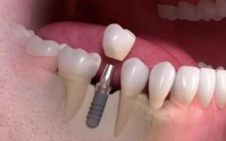 3D render of a single dental implant - great for replacing a single tooth.