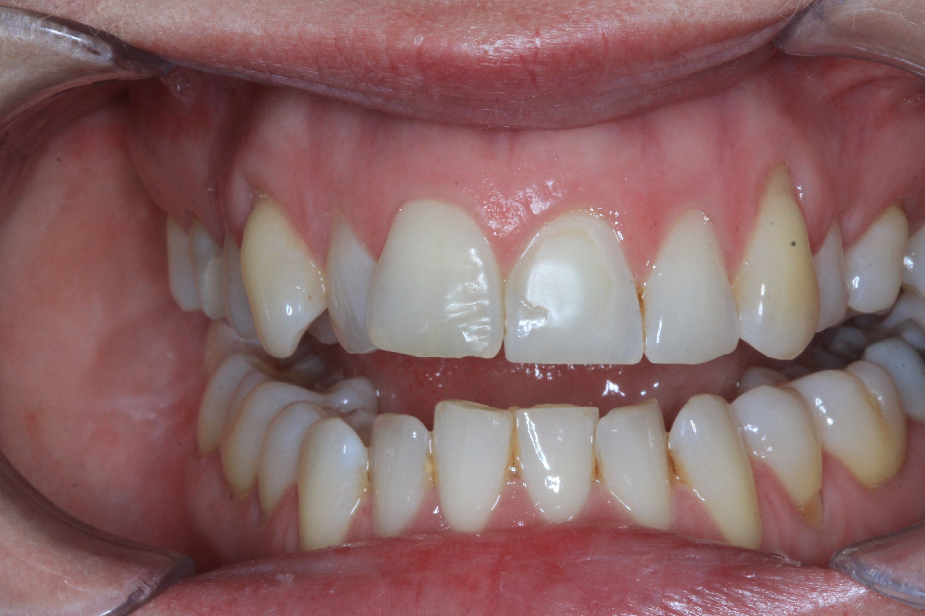 before veneers