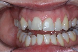 before veneers