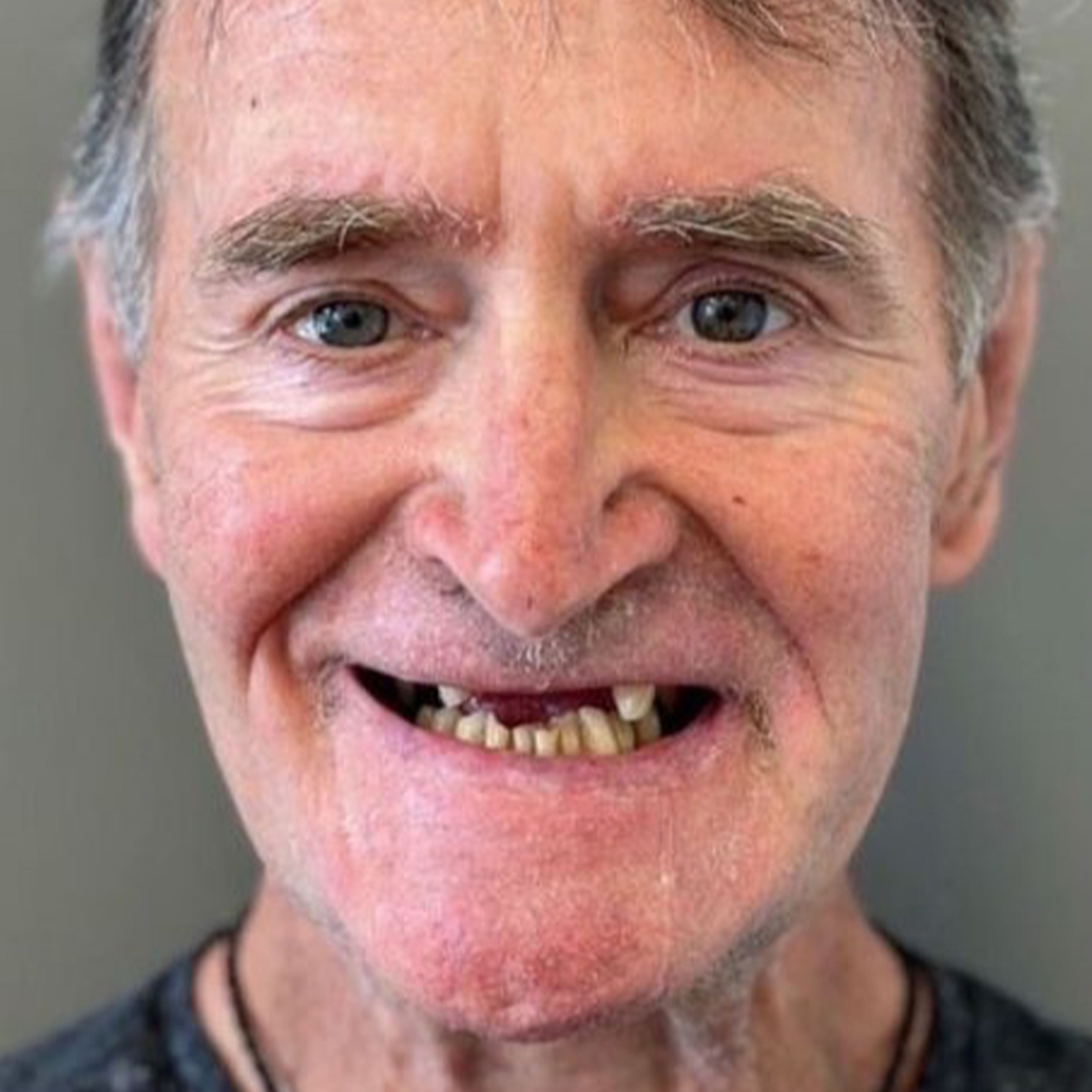 Upper Partial Denture Before