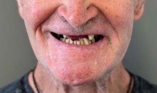Upper Partial Denture Before