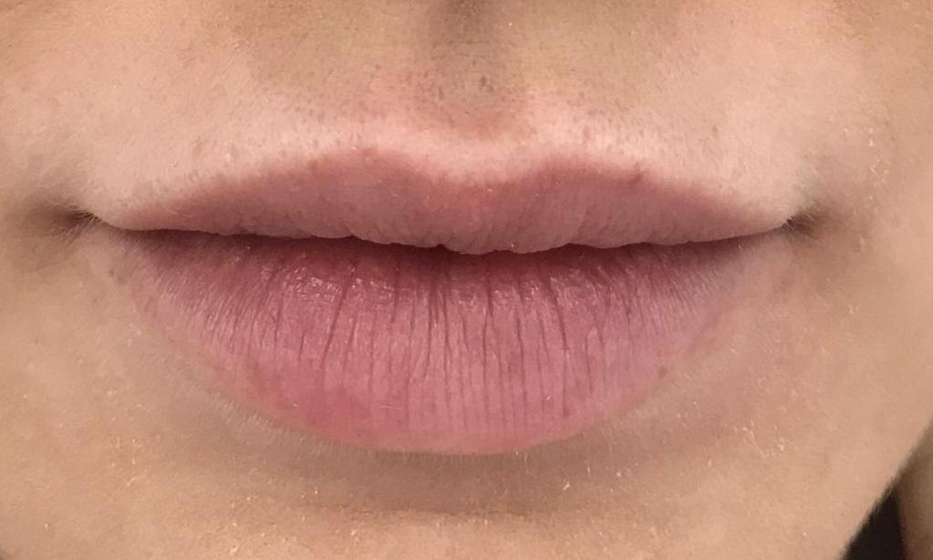 Facial Aesthetics - Before