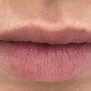 Facial Aesthetics - Before