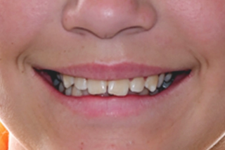 Mal Occlusion treatment - before