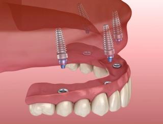 What Are All‑on‑4 Implants?