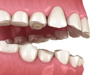 Dangers of teeth grinding