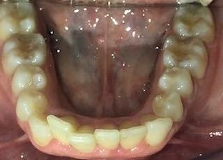 Braces and Invisalign -Before