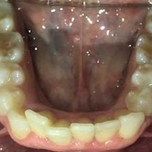 Braces and Invisalign -Before