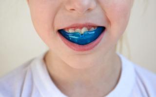 Boil-and-Bite mouthguard