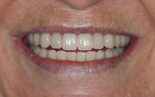 After image of a patient of dental implants. 