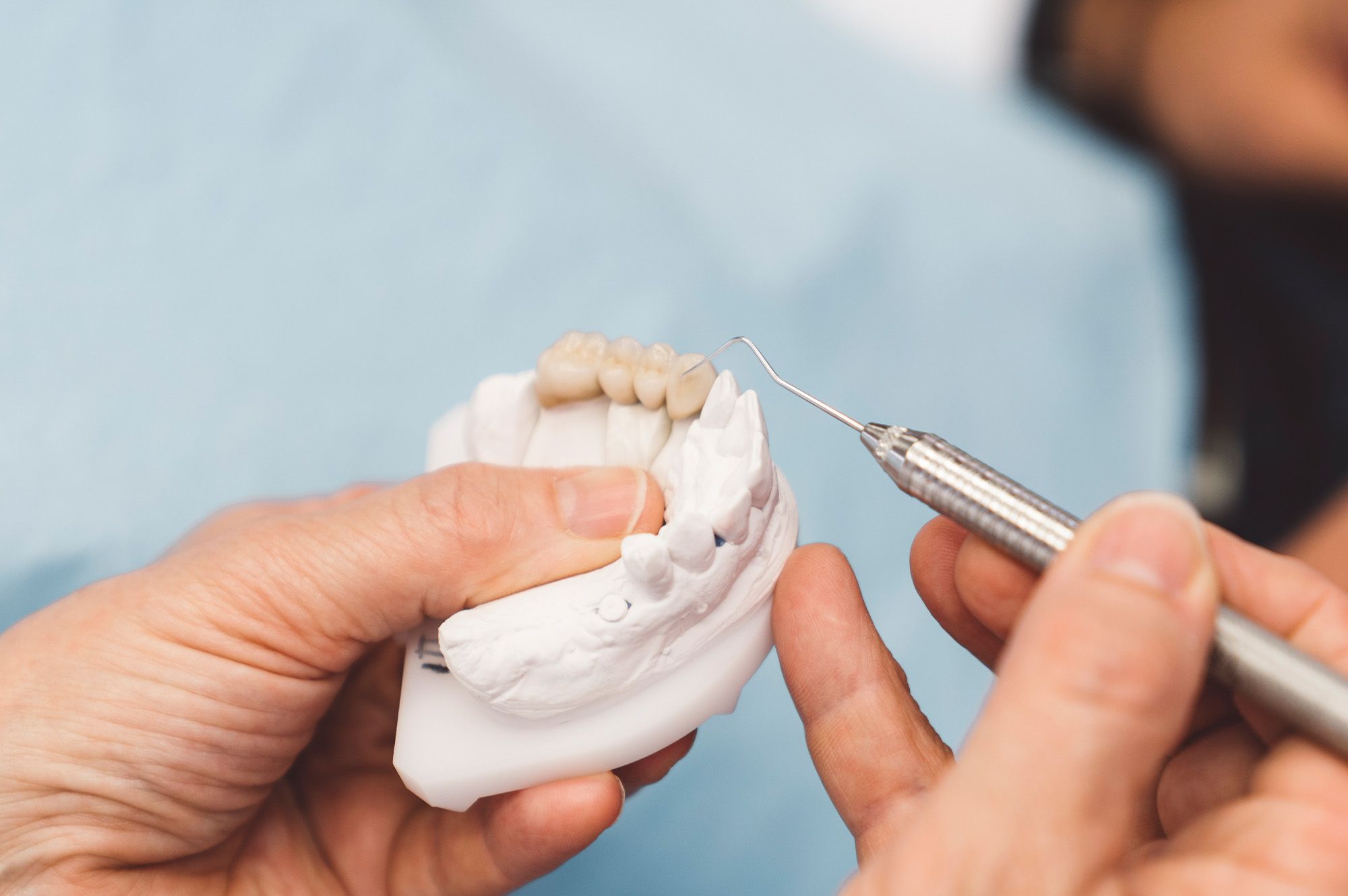 Image of a dental bridge on a plastic jaw.