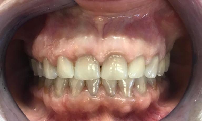 Cosmetic Dentistry - Before