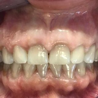 Cosmetic Dentistry - Before