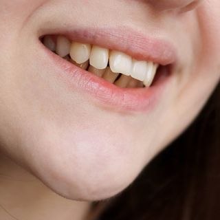 Image of a female with an overbite.