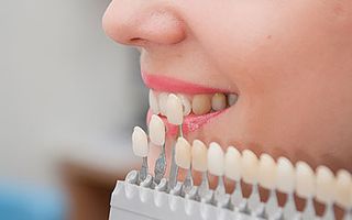 Dental veneers - before and after