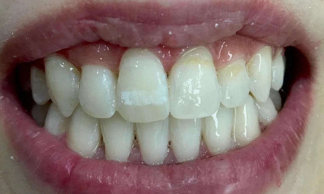 Cosmetic Dentistry - After
