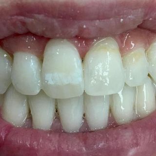 Cosmetic Dentistry - After