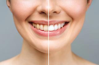Teeth whitening treatment before and after