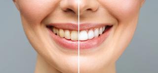Discoloured Teeth