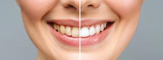 Benefits of Professional Teeth Whitening
