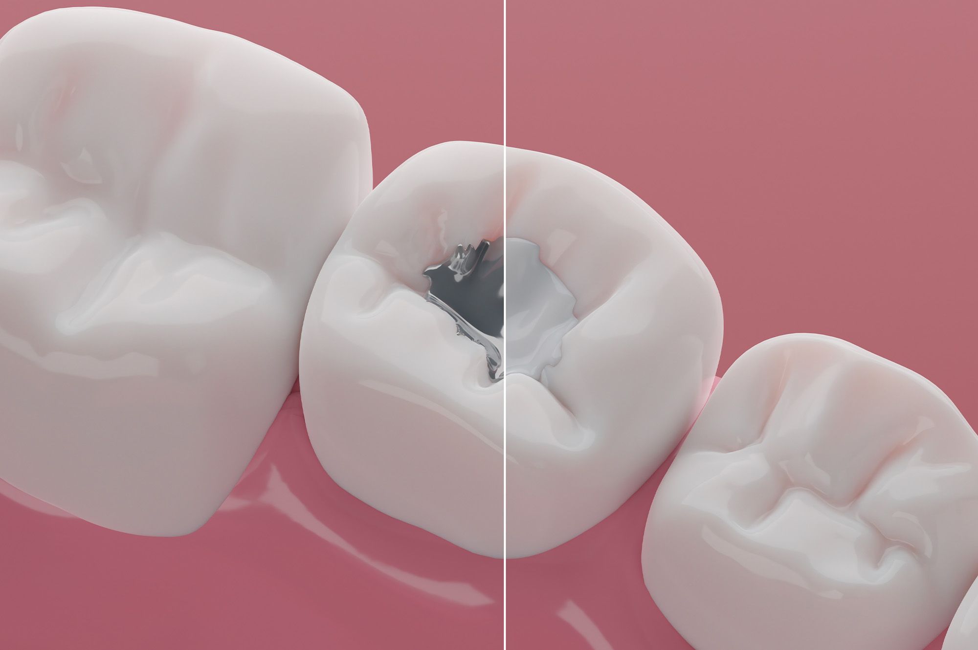 Composite fillings & Silver amalgam fillings