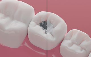 Fillings