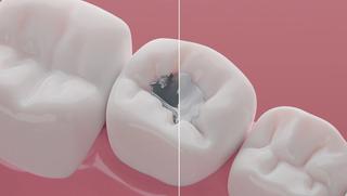 Repair Cavities