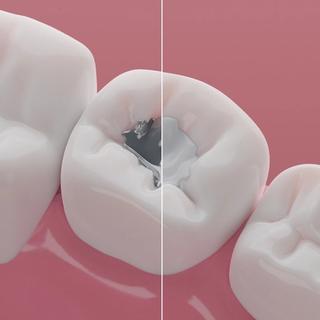 Composite fillings & Silver amalgam fillings